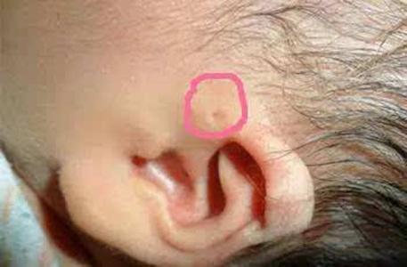 你家宝宝耳朵上有这种小孔吗 如果有,可要小心了