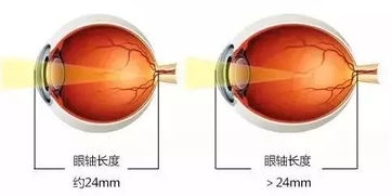 高度近视眼怎么办 高度近视眼怎么恢复视力