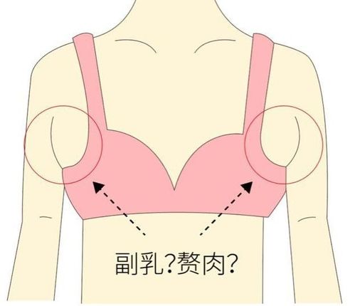 副乳怎么消除 广州高尚形体雕塑解读篇