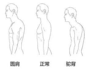 圆肩驼背怎么矫正 教你如何矫正圆肩驼背