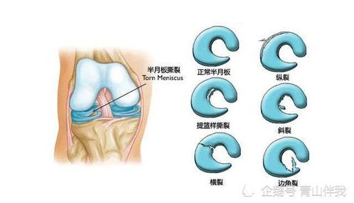 半月板损伤能走路吗