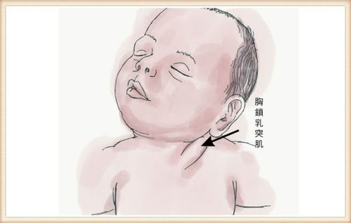 婴儿斜颈(宝宝斜颈一般在几个月出现)