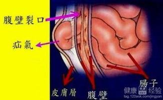 小时候做过疝气手术会不会影响大脑发育的