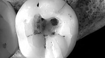 新研究揭示史前人类最早如何治疗蛀牙 