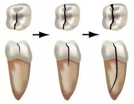 牙隐裂的病因及治疗