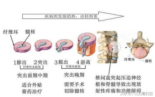 腰椎间盘突出做完手术,为什么还会腰痛 