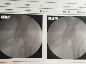 股骨头去上海在哪里可以放心治疗？