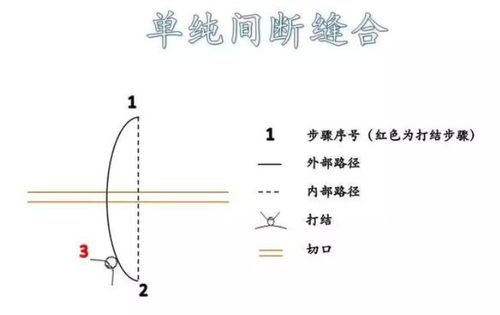 常见临床伤口缝合方法 图文解析