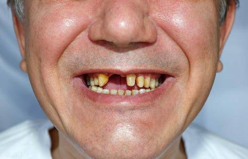 老年人一般多少岁才开始 掉牙 牙齿脱落后,需要注意什么
