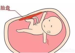生完孩子后,胎盘是带走还是由医生处理