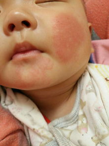 请问五个月宝宝脸上长了湿疹,脸蛋发红不消,是什么原因 
