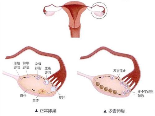 患有多囊还可不可以生宝宝,注意什么