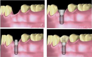 做种植牙的过程是怎样的 