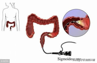大肠癌高危人群 粪常规 肛门指检 肠镜这三大早期诊断法要了解 