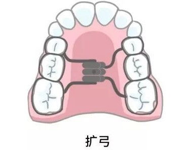 重庆牙齿矫正 什么是非拔牙矫正中的扩弓