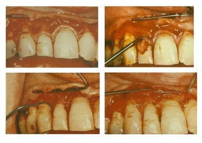 牙周翻瓣术的手术操作 