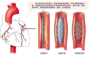 心脏支架是暴利收费 有人花两三万,有人却要十几万 