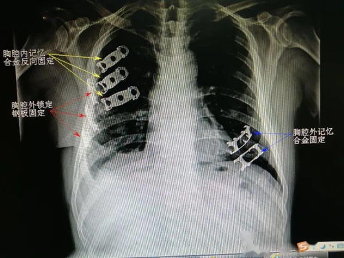 肋骨骨折手术费用多少 搜狗图片搜索