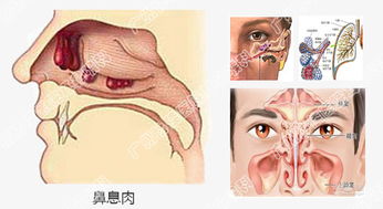 鼻息肉对于儿童造成哪些严重的危害 鼻息肉的疗法 