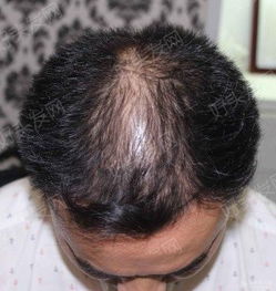 植发案例 毛发种植案例 真实植发案例对比图 好头发网 