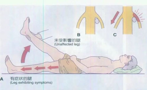 疼痛辟谣 直腿抬高测试阳性 椎间盘突出 直腿抬高试验全新解读