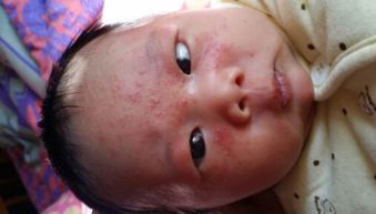 湿疹 婴儿 婴儿湿疹有什么办法根治