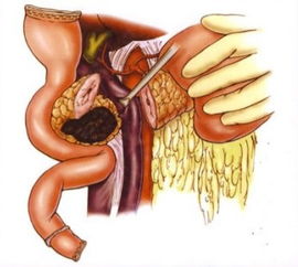 中医治疗胰腺癌晚期