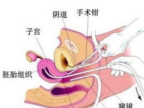 我是因为连续做了两次刮宫术后九个月没来月经，还有时有乳房胀痛、溢乳，每个月都伴有几天腹痛，请问专家到底是怎么回事？我是得的什么病？怎么治疗？多谢了！