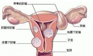 子宫肌瘤是良性恶性