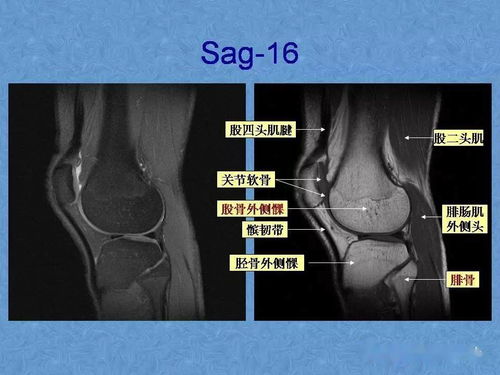 正常膝关节mri解剖图谱 信息图文欣赏 信息村 K0w0m Com