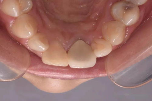 上前牙根管再治疗后内漂白一例