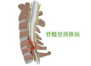 颈椎病怎么治疗好 治疗颈椎病最好的方法是什么