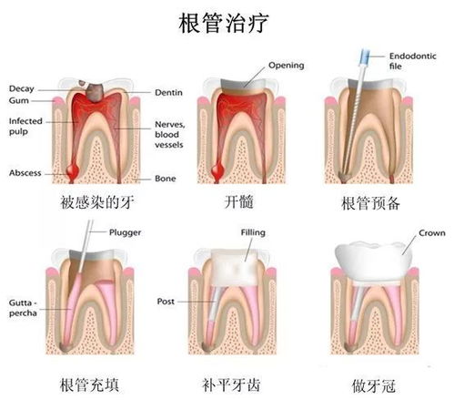 7个问题为你解释,牙痛为什么要采取根管治疗