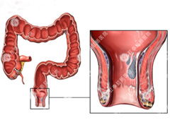 肛门异物是怎么回事 需要上医院吗
