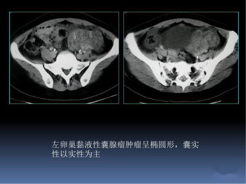 5大卵巢恶性肿瘤,如何在CT上寻找蛛丝马迹