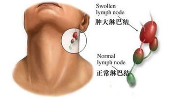 颈部淋巴结肿大症状 颈部淋巴结炎的症状有哪些