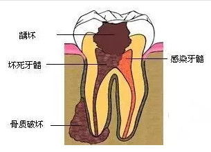 芽美口腔 虫牙 为什么有人疼,有人不疼