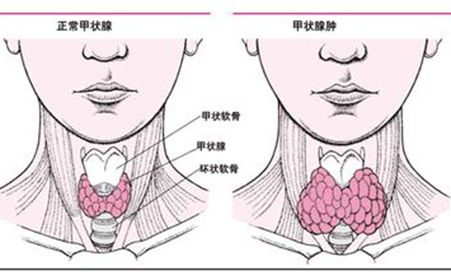 甲状腺炎有哪些饮食疗法