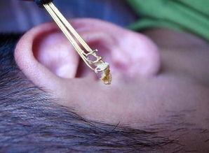 为什么耳鼻喉医生会提醒 不能用棉签棒掏耳朵 