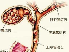 广州治疗胆囊息肉医院