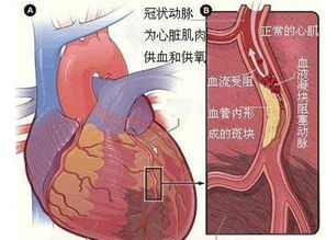 心肌梗塞吃什么好 心梗病人吃什么好