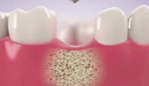 种植牙怎么弄好看 种牙后的感觉是什么样的