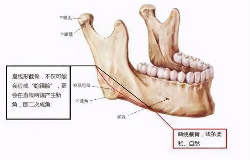 单纯磨骨与下颌骨截骨手术应该如何选择