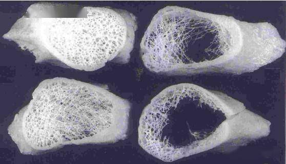什么是骨质疏松症得了骨质疏松该怎么办