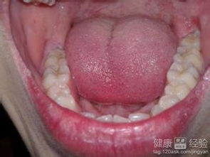 牙齿拔冠是什么