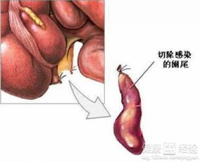 阑尾炎手术后内有硬块怎么办