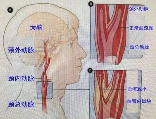 经常感到头晕 可能是颈动脉堵了 为你介绍3个疏通方法