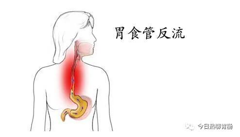 胃食管反流病 九成患者没用对药 胃食管反流用药误区有哪些