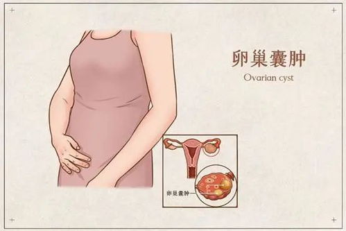 女子体检查出卵巢囊肿未重视！拖延5年竟变成巨大肿物