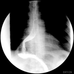 食道胃发育异常 体检发现 X片, GI, CT